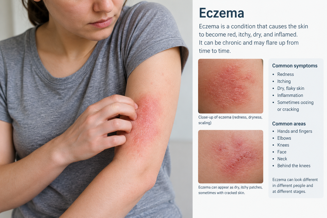 What is eczema?